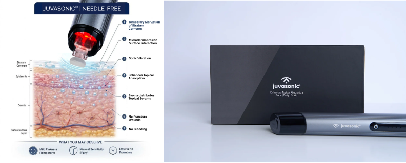 Juvasonic® treatment illustration